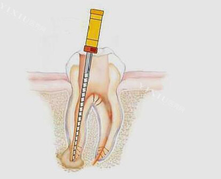 根管治疗展示图照片