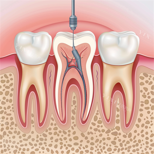 牙齿根管治疗牙髓问题漫画图