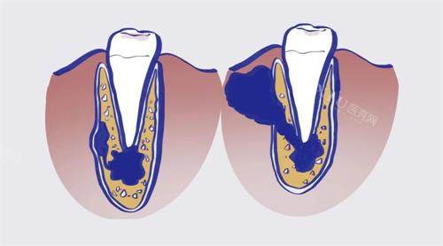 根尖囊肿不治疗的后果有：损伤邻牙｜破坏颌骨｜发炎｜骨髓炎多种危害揭秘！(图1)