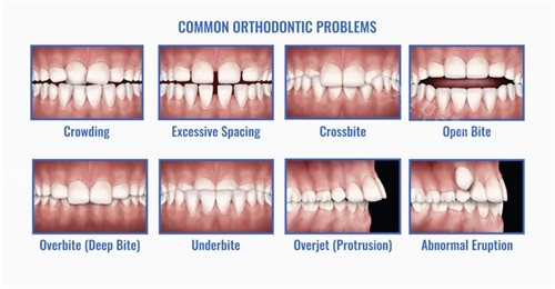 各种牙齿错合畸形问题