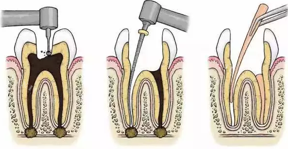 根管治疗过程