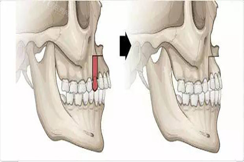 正畸小课堂：深覆合下巴会越来越短吗？可能影响+改善建议+术后注意事项一览(图2)