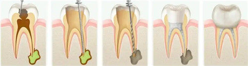 根管治疗步骤图