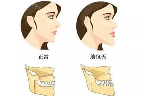 反颌对比卡通示意图