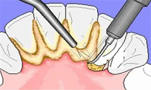 洗牙结石照片