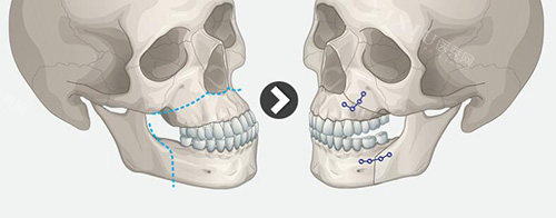 双鄂整形手术卡通对比
