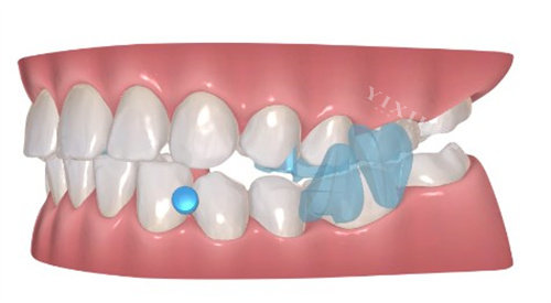 正雅GS隐形矫正示意图