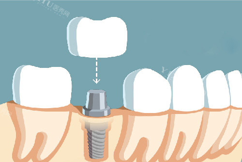 韩国奥齿泰种植体怎么样？文内从品牌背景／技术优势／临床表现／患者反馈／价格等方面为您深入解析下！(图3)