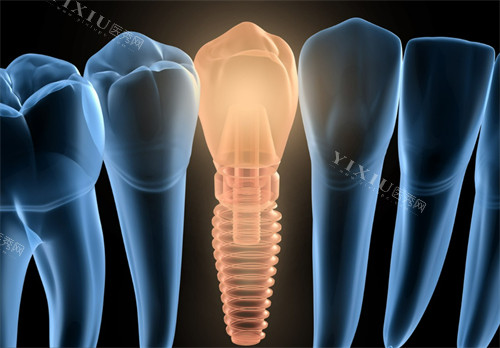 韩国奥齿泰种植体怎么样？文内从品牌背景／技术优势／临床表现／患者反馈／价格等方面为您深入解析下！(图2)