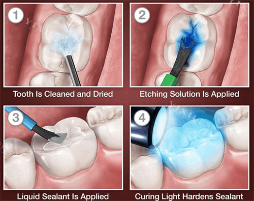 警惕！做窝沟封闭把孩子坑了！先查询做窝沟封闭的好处和坏处、副作用，家长必看！(图4)