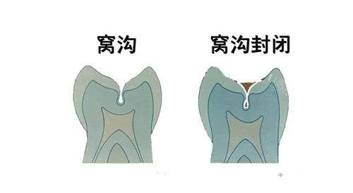 窝沟封闭前后的对比图