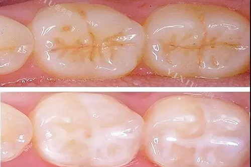 警惕！做窝沟封闭把孩子坑了！先查询做窝沟封闭的好处和坏处、副作用，家长必看！(图3)