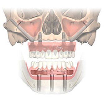 全口穿颧种植牙透视图