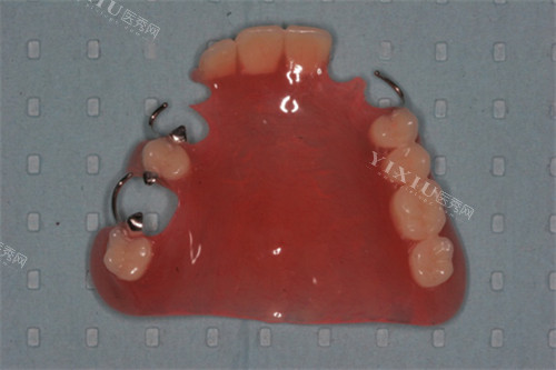 半口可摘局部义齿展示图