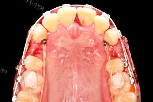 正畸拔牙示意图