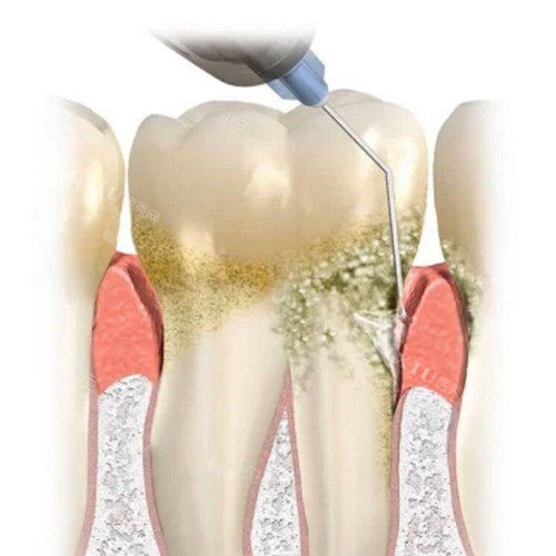 牙周刮治图片
