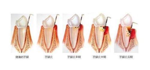 警惕！8个症状说明已有牙髓炎，怎样确定是不是牙髓炎，看牙髓炎有什么症状出现(图1)