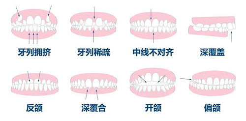 牙齿矫正正畸适应症