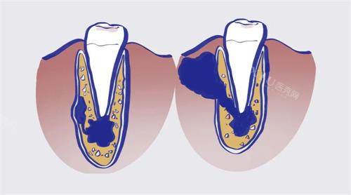 根尖周炎漫画图