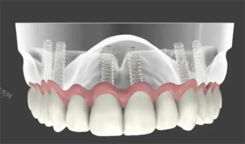 全口种植牙解析图