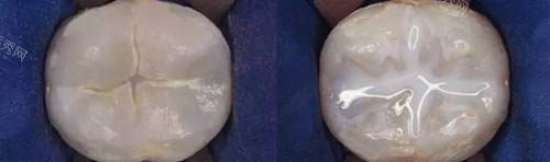 宝妈必看！3m涂氟和普通涂氟有什么区别？从材质、价格、优缺点等多方面来分析(图4)