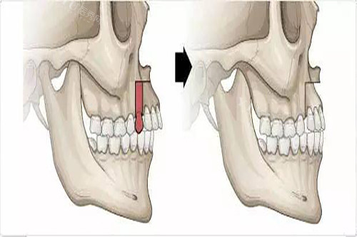 骨性凸嘴正颌示意图