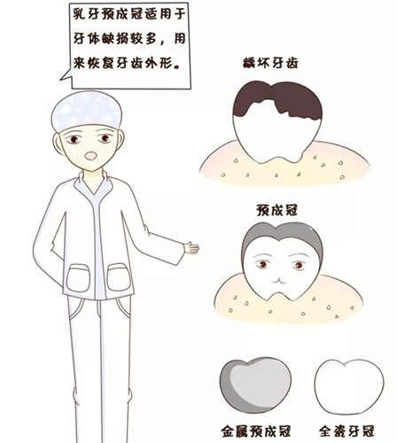 医生讲解儿童乳牙预成冠及金属和全瓷预成冠漫画图