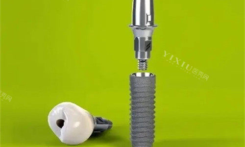 以色列丹特因植体型号特点介绍，做种植牙优势特点鲜明收费合理值得了解！(图4)