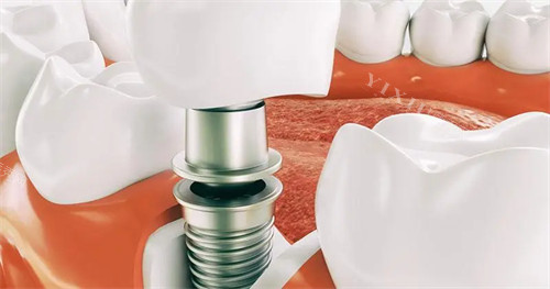 曝光！2024下半年本溪种植牙一颗多少钱？国产3800+／韩系6000+／德系8800+(图3)