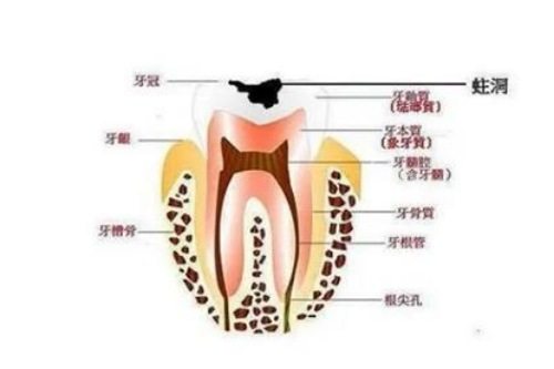 牙髓炎示意图