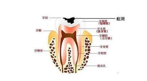 牙髓炎示意图