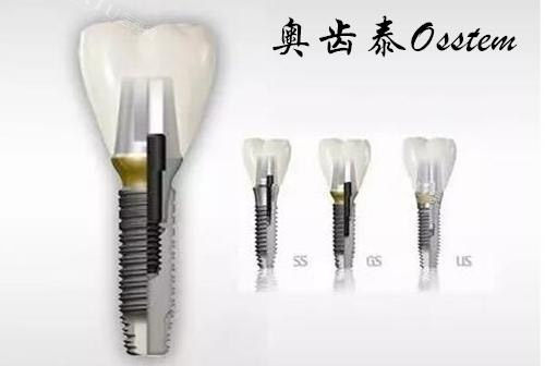 韩国奥齿泰种植牙寿命及价格揭秘，能使用多长时间？价格多少钱？一文读懂！(图3)