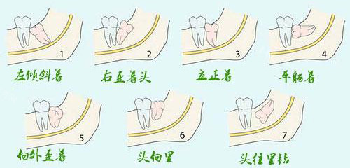 智齿小知识科普：拔智齿后疼痛会持续多久？疼痛时间、难熬的三个阶段、注意事项解析(图1)