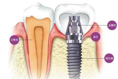种植牙的组成介绍