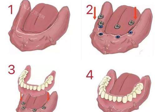 详解吸附式假牙的优点和缺点，舒适易清洁但需要适应期！(图1)