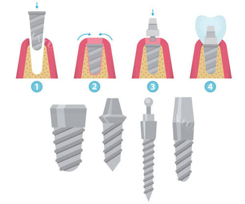 种植牙步骤和植体型号
