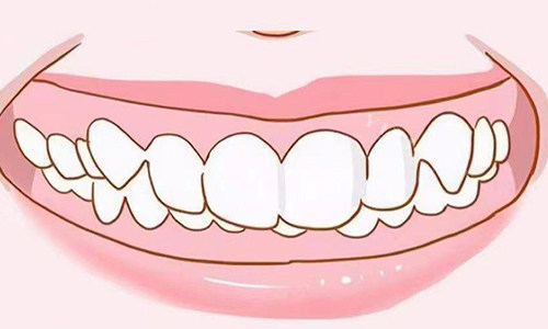 正畸前必看：孩子做牙齿矫正的利与弊分析！这几种情况建议必做矫正！(图1)