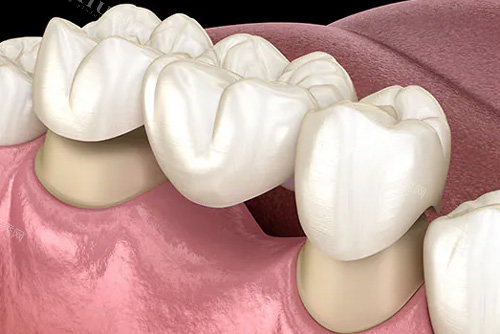 牡丹江张月鹏口腔镶牙价格贵吗？不贵！文内有详细的优势及价格的介绍！(图1)