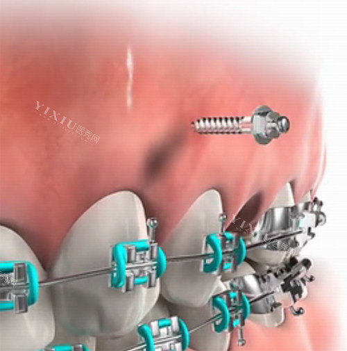 正畸支抗钉演示图