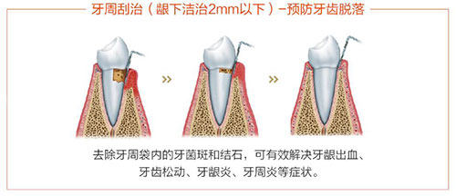 洗牙龈下刮治过程示意图