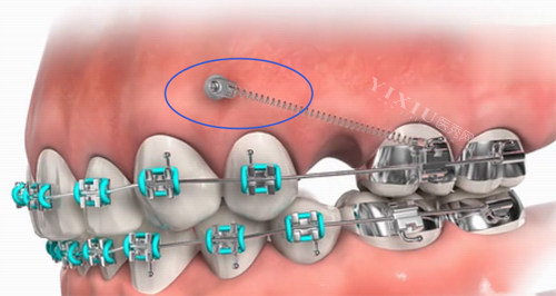 正畸支抗钉的照片