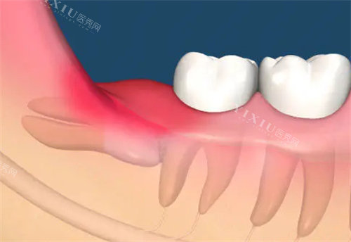 智齿连着下颌神经能拔吗？非必要不建议拔除！难度大易造成面部神经损伤！(图2)