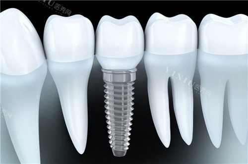 单颗种植牙图示