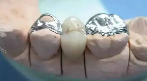 牡丹江张月鹏口腔镶牙价格贵吗？不贵！文内有详细的优势及价格的介绍！(图2)