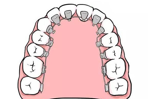 舌侧矫正器卡通示意图