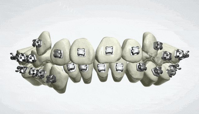 奥世美数字化正畸定位模型示意图