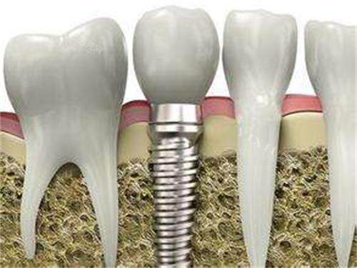 韩国多普勒种植体多少钱？价格大概在6000元起！不同型号价格不同~(图3)