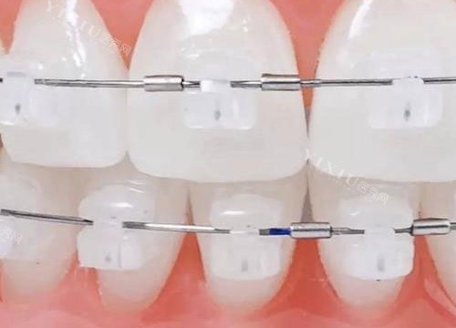 本溪牙齿矫正多少钱？2024本溪正畸价格表揭秘，传统矫正5000+隐形矫正18000+(图1)