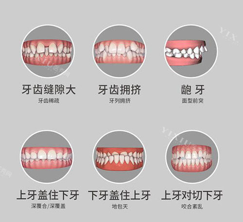 6种牙齿需要正畸改善类型