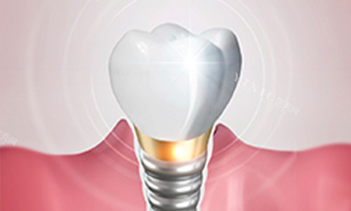 韩国多普勒种植体多少钱？价格大概在6000元起！不同型号价格不同~(图1)